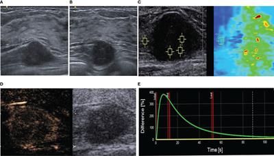 Multimodal ultrasonography findings of extramammary granular cell tumors: Two case reports